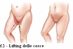 lifting cosce