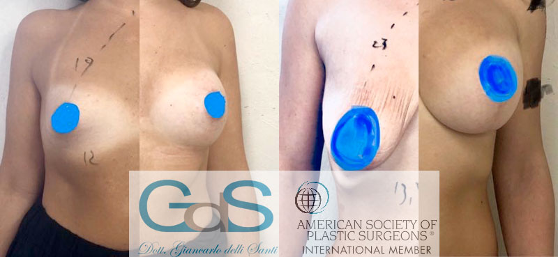 foto chirurgia estetica della mammella
