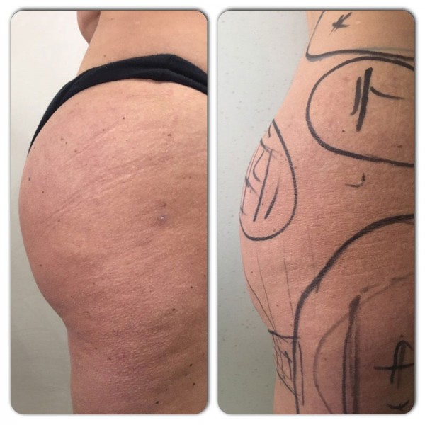 Foto Lipofilling Glutei Prima e Dopo